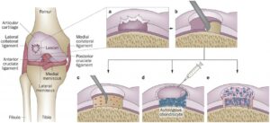 Repairing Damaged Cartilage: Surgical Techniques and Innovations