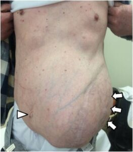 Identifying Internal Stitch Issues After Hernia Surgery