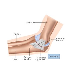 Understanding UCL Tears in the Elbow