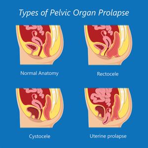 Post-Operative Bathing Guidelines After Rectocele Surgery