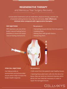 Recovery Timeline After Meniscus Surgery