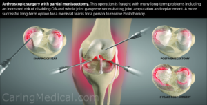 Risks of Knee Damage Post-Meniscus Surgery