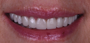 Repairing Worn Teeth with Porcelain Veneers