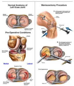 Walking After Meniscus Surgery: What You Need to Know