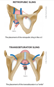 Can a Bladder Sling Come Loose? Understanding Erosion and Management