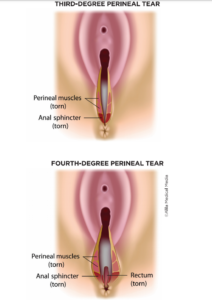 Postpartum Exercise After Perineal Tear: Guidelines and Recommendations