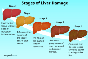 Reversing Liver Damage: Understanding Recovery Potential