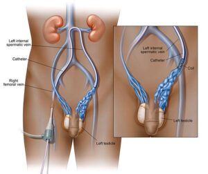 Pregnancy After Varicocele Surgery: Timing and Expectations