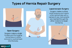 Returning to Running After Hernia Surgery