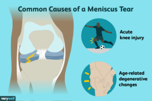 Understanding Meniscus Tears: Symptoms and Diagnosis