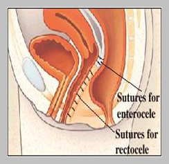 Understanding Rectocele Stitches Dissolution and Recovery