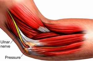 Can Ulnar Nerve Damage Be Reversed?