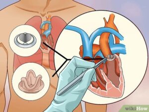 Understanding Heart Murmurs: Causes, Prevention, and Management