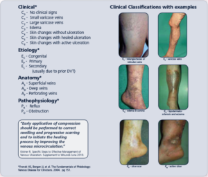 Understanding Complications of Varicose Vein Surgery